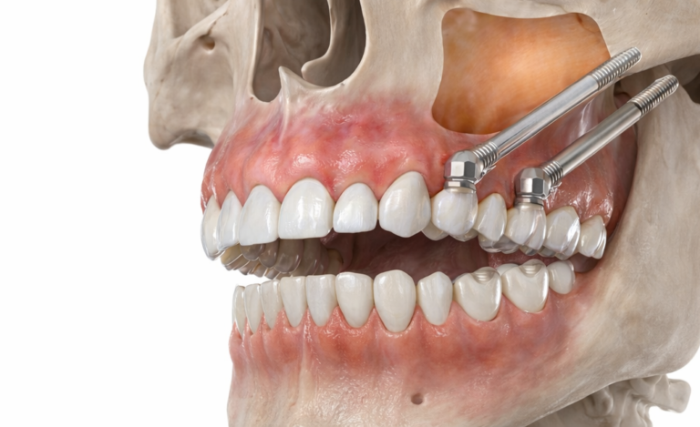 impianti pterigoidei luciano tarabini