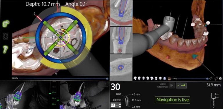 implantologia dentale guidata tecniche, risponde l'esperto dottor luciano tarabini