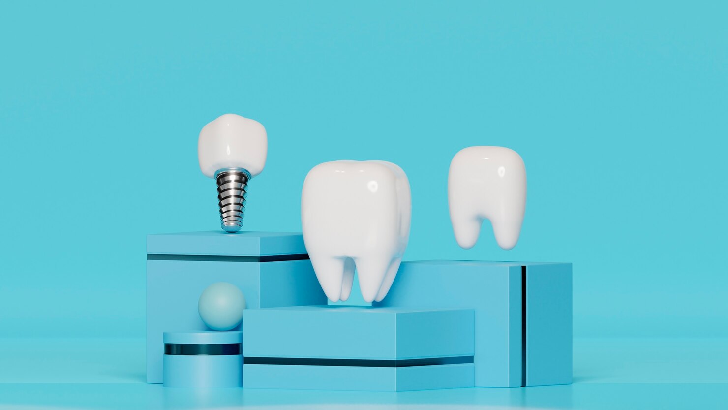 mini impianti dentali cosa sono come funzionano