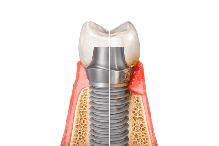 perimplantite cos'è come si cura e prevenzione